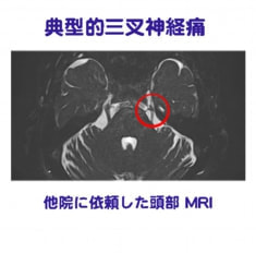典型的三叉神経痛　MRI